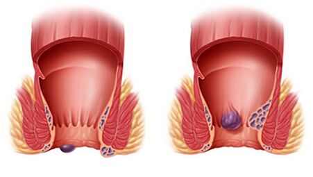 Proctonic ayuda con todo tipo de hemorroides